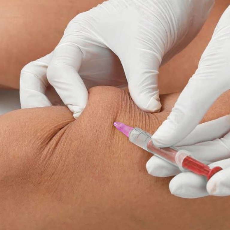 Mesoterapia Antalgica